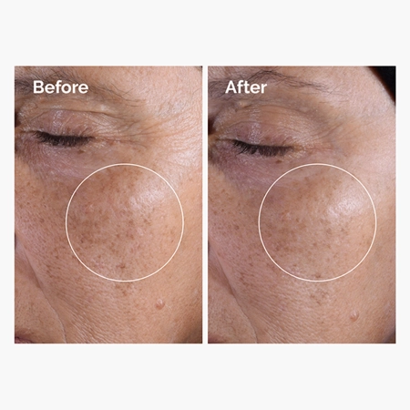 The Ordinary - Glycolic Acid 7% Exfoliating Toner - Toner exfoliant cu 7% acid glicolic - 100 ml