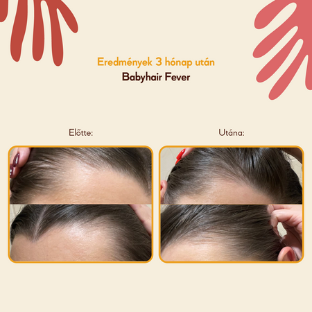HairTry - Babyhair Fever - Loțiune încălzitoare pentru creșterea părului - 200 ml